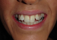 Composite veneers 1