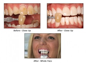 teeth whitening wellington